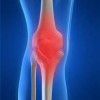 what is arthritis?